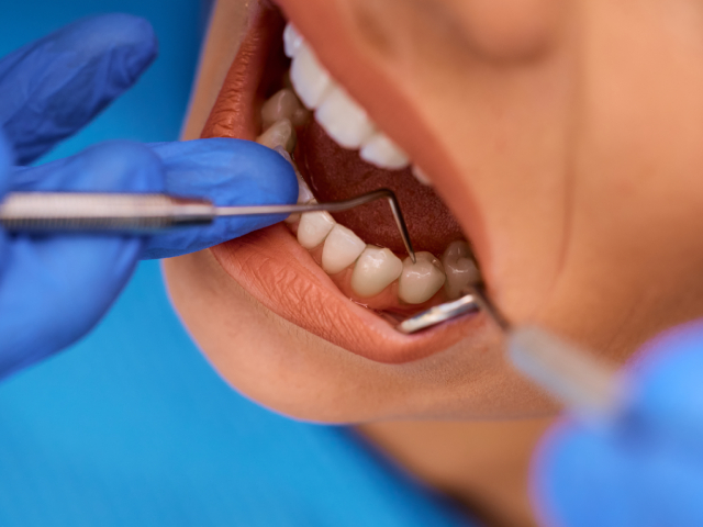 Periodontal Maintenance