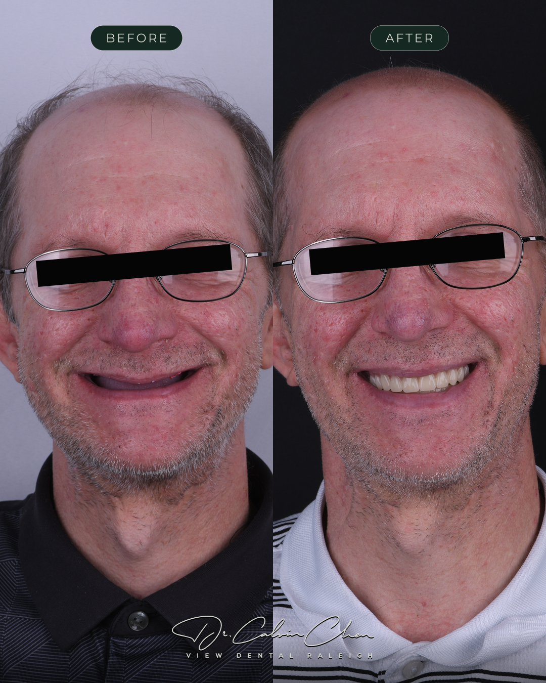 VD-BeforeAndAfter12 (1)