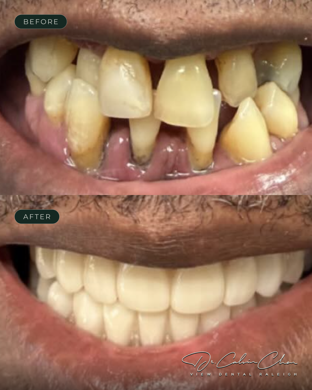 VD-BeforeAndAfter14 (1)