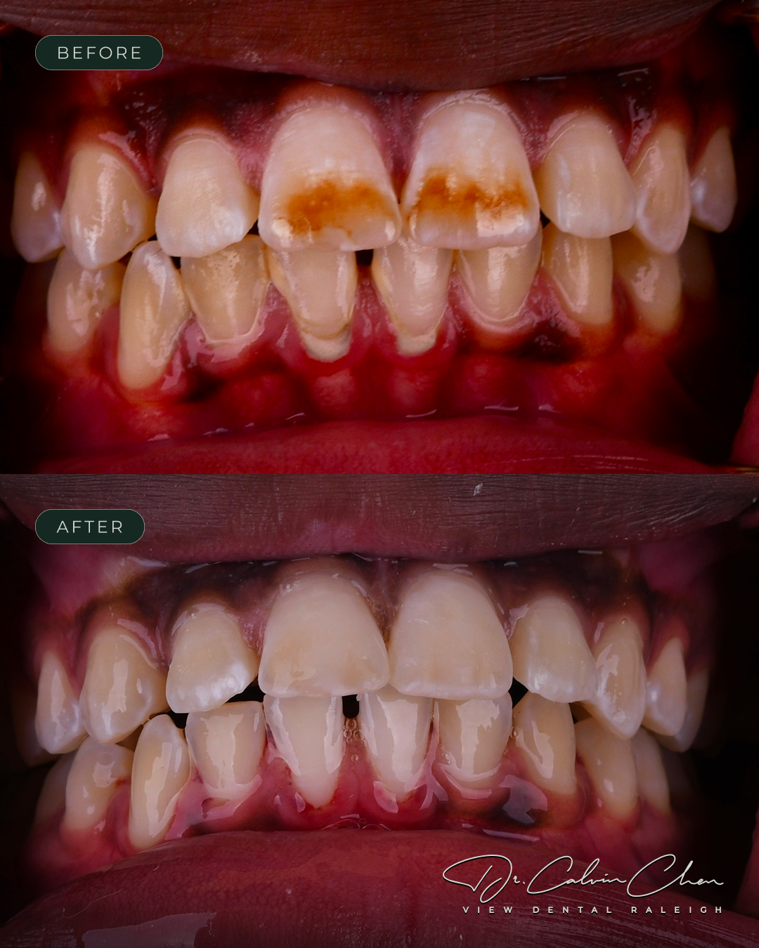 VD-BeforeAndAfter15