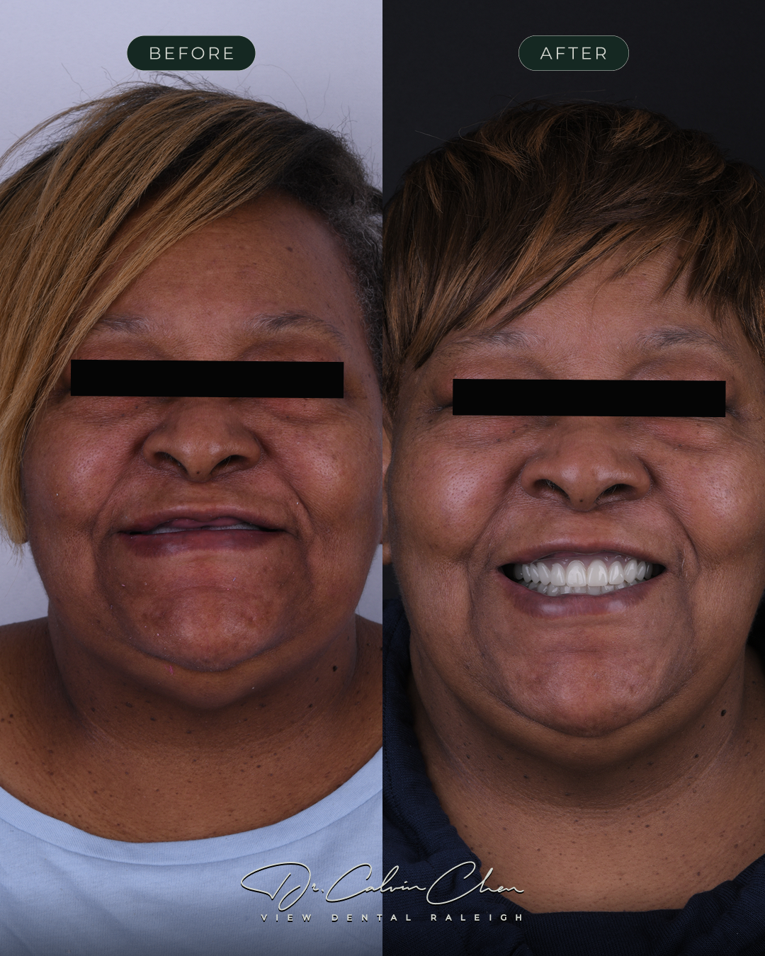 VD-BeforeAndAfter16 (1)